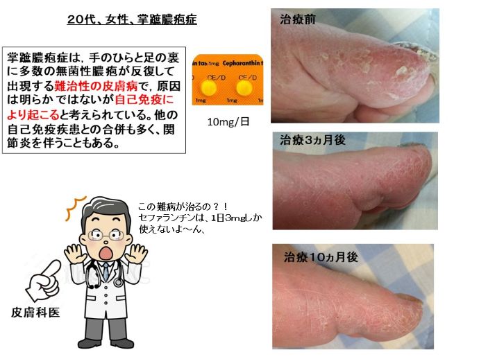 円形脱毛症　病院